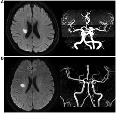 Clopidogrel Plus Aspirin in Patients With Different Types of Single Small Subcortical Infarction